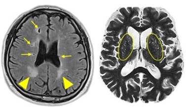 뇌백질 고신호 병변(좌측 사진 화살촉), 열공성 뇌경색(좌측 사진 화살표), 확장성 혈관주위 공간(우측 사진 양쪽 타원 안쪽의 하얀 점들)이 나타난 뇌 MRI 사진.