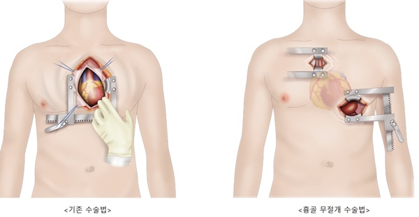 인공심장 수술 비교.