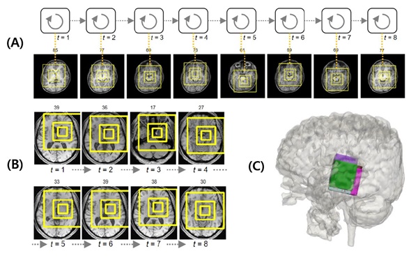 A. 세브란스병원 ASD 환자의 MRI 빅데이터에서 인공지능 모델이 자폐 중증도와 관련된 뇌 주요 부위들의 연관 관계를 찾아내는 모습 B. 국제컨소시엄으로 구축된 1000여 건의 자폐증 환자 MRI 빅데이터에서 인공지능 모델이 자폐 중증도와 관련된 뇌 주요 부위들의 연관 관계를 찾아내는 모습 C. A와 B의 주요 부위를 3차원으로 표현한 뇌 이미지.