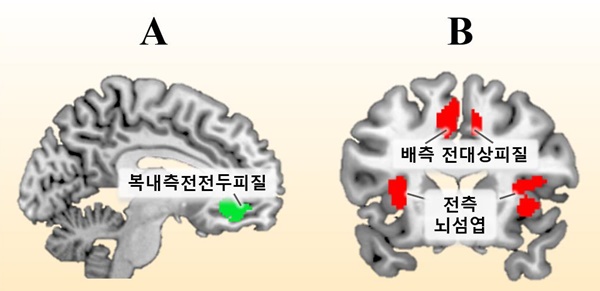 A. 신체질환자, B. 정신질환자에게 위로와 격려를 보냈을 때, 이를 바라보는 정상인의 뇌를 기능적 자기공명영상(fMRI)으로 촬영했다. 각각 활성화 부위가 다른 것을 볼 수 있다.