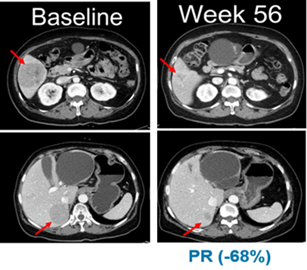 임상 시작 전(Baseline,좌측)과 벨바라페닙 투여 56주 후 흑색종 환자의 복부 CT사진.