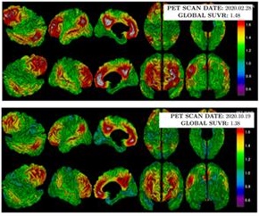뇌혈관장벽 개방술 전(위), 후(아래) 아밀로이드 PET 검사 결과, 후 사진에서 아밀로이드 양과 범위(회색+빨간색)가 감소한 것을 확인할 수 있다.(사진 세브란스 제공).